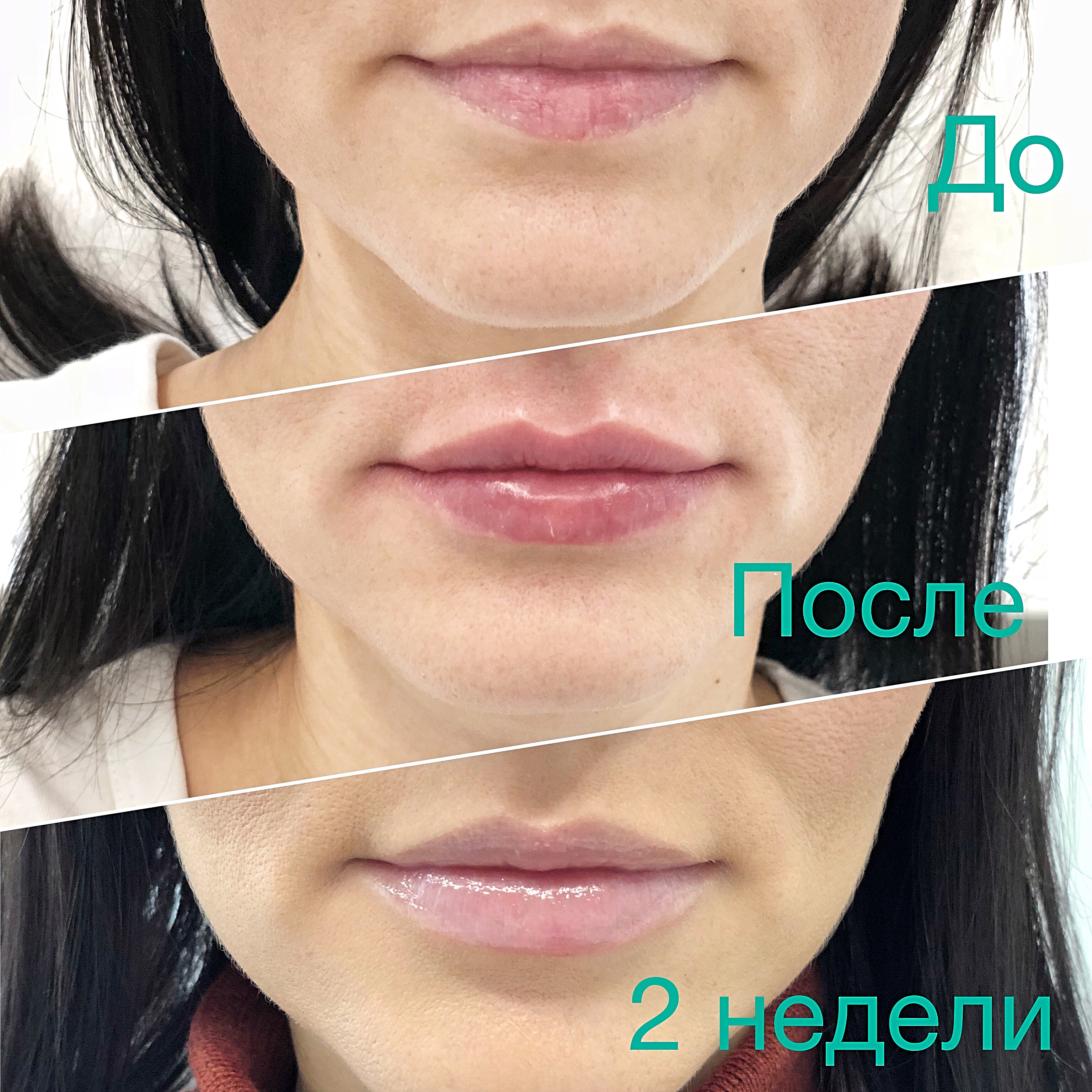 Увеличение губ на 1 мл фото до и после заживления